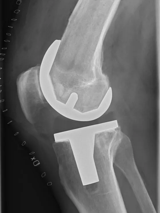 X-ray of a knee replacement, side view