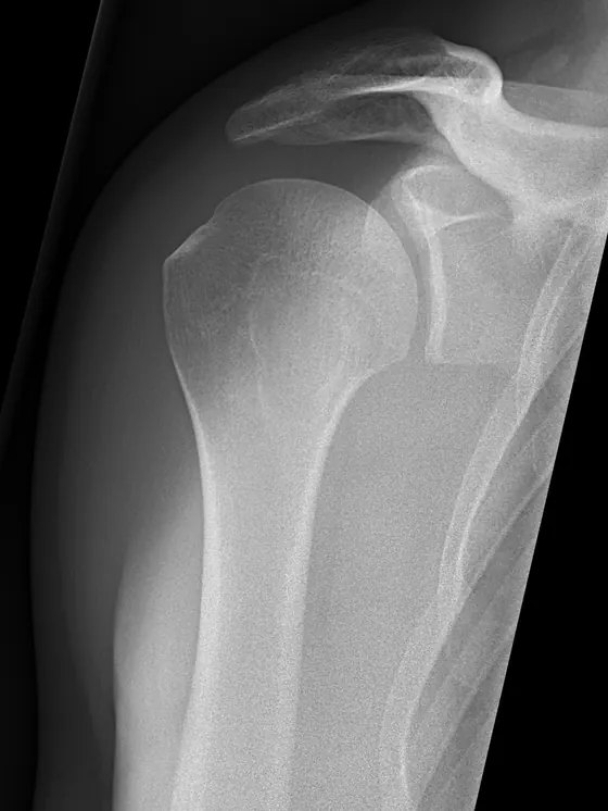 X-ray of a shoulder joint, front view
