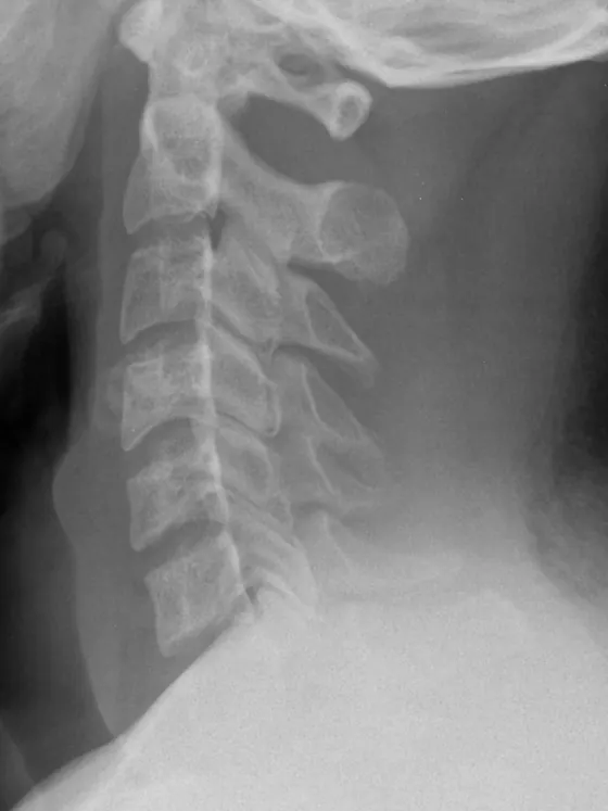 X-ray of the neck (cervical spine), side view