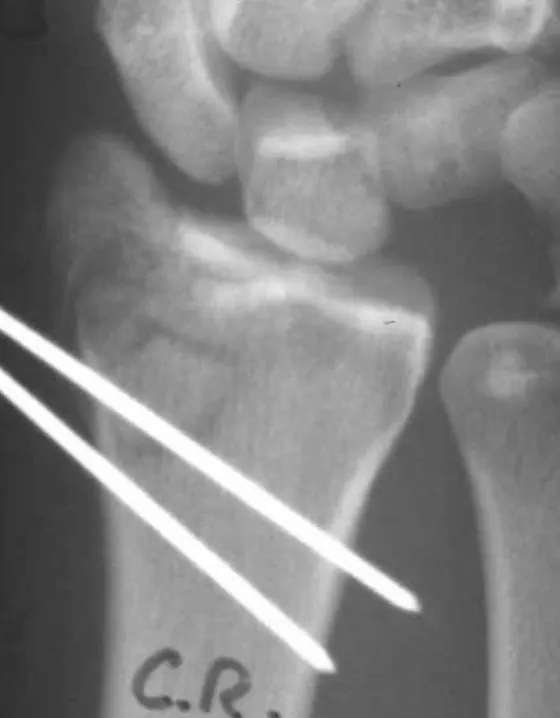 X-ray of a wrist fracture held with pins